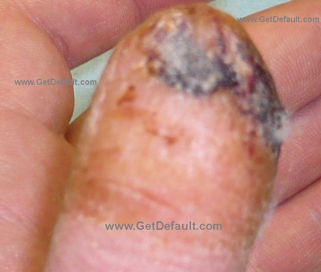 1 month after finger tip amputation