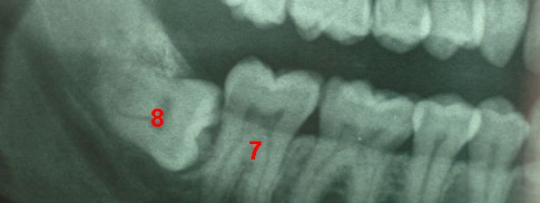 8 tooth damaging 7